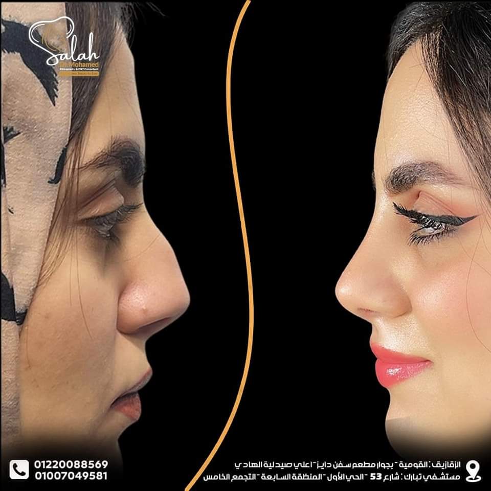 Crooked Nose Rhinoplasty